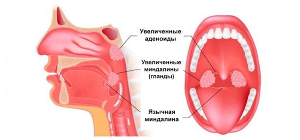 Тонзиллит — причины, симптомы, диагностика и лечение в Астрахани | Болезни | Клиника «Консилиум»