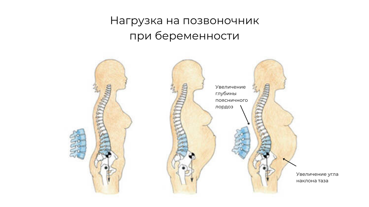 Как беременность влияет на осанку? | Vолшебник страны сколиОZ | Маслов  Роман | Дзен