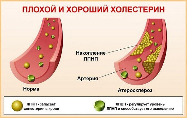 Холестерин хороший и плохой