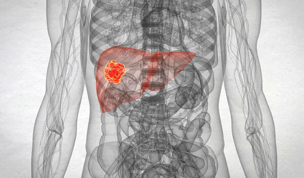 Метастазы в печени - причины появления, ранние признаки и последствия