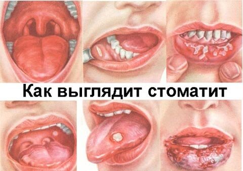 Источник: https://ozubkah.ru  