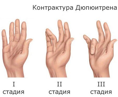 стадии (степени) развития контрактуры Дюпюитрена. Фото из интернета 