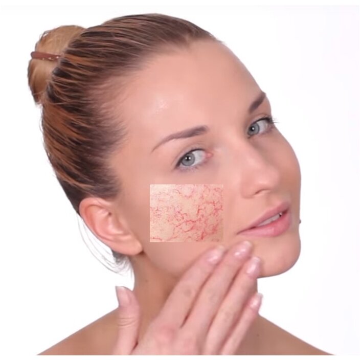 Куперозная сетка