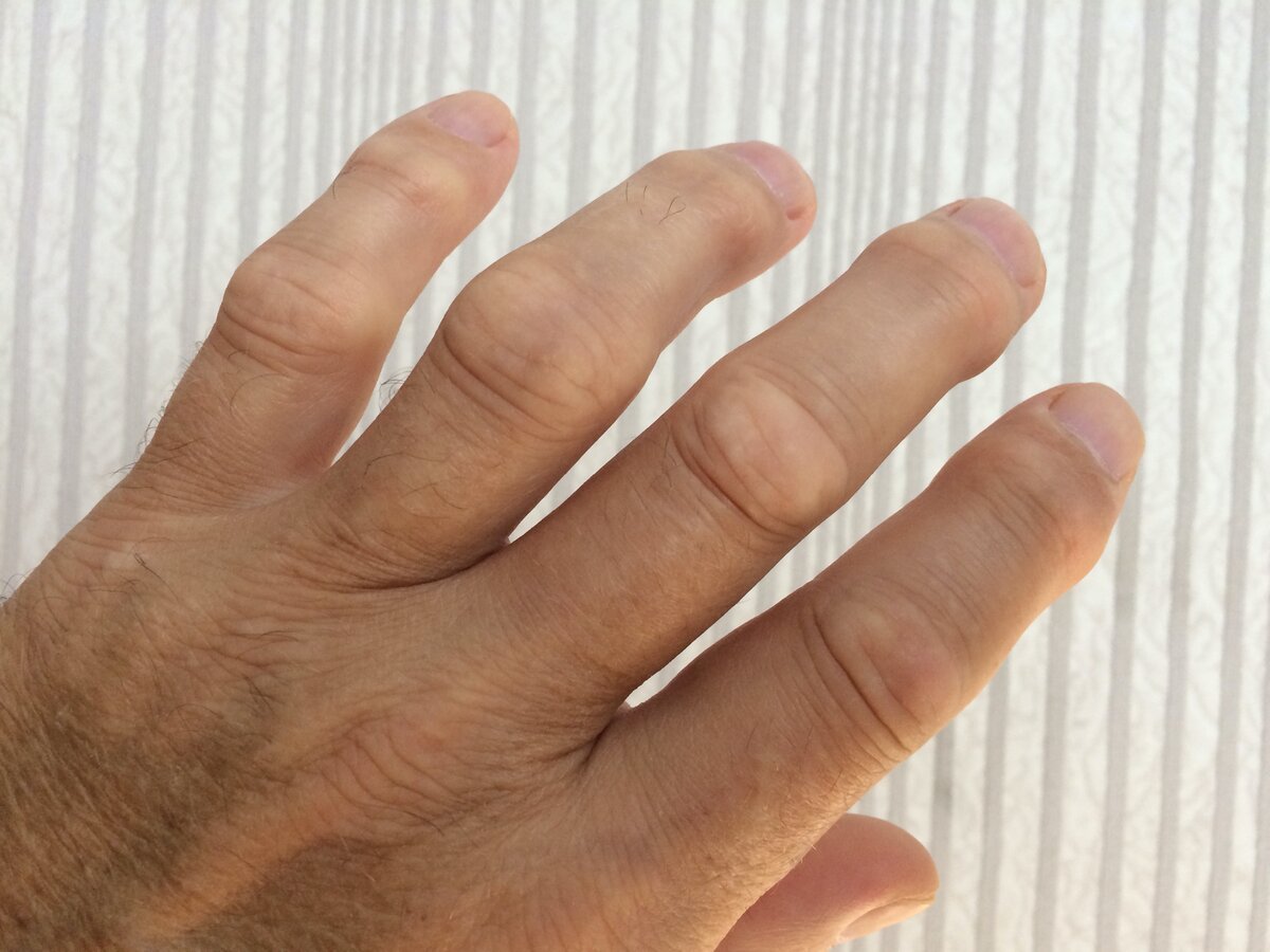 Можно ли победить артрит