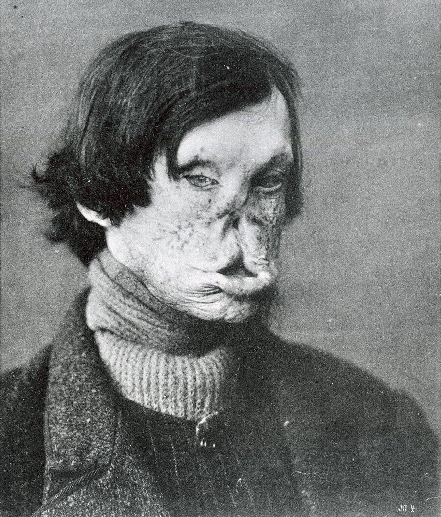 Фото человека, который болен проказой, 1895 год.