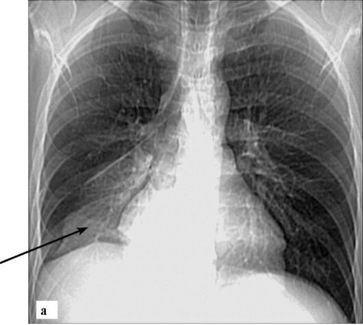 Правосторонняя нижнедолевая пневмония на рентгенограмме