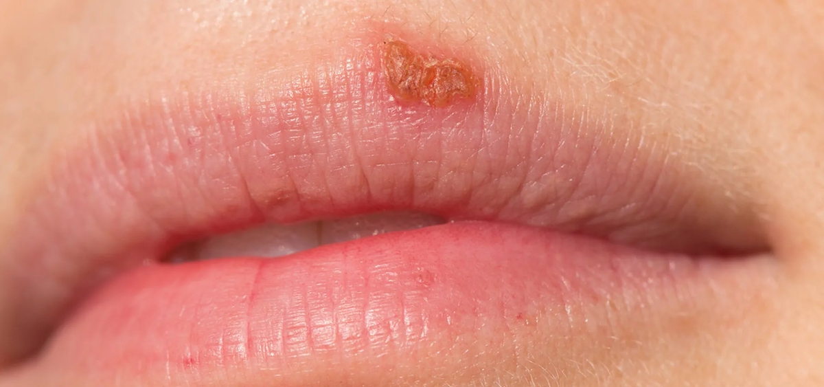 Простуда на губах