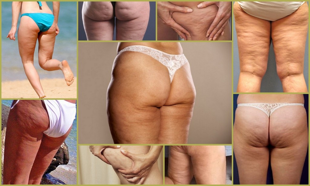 Дряблая кожа при целлюлите