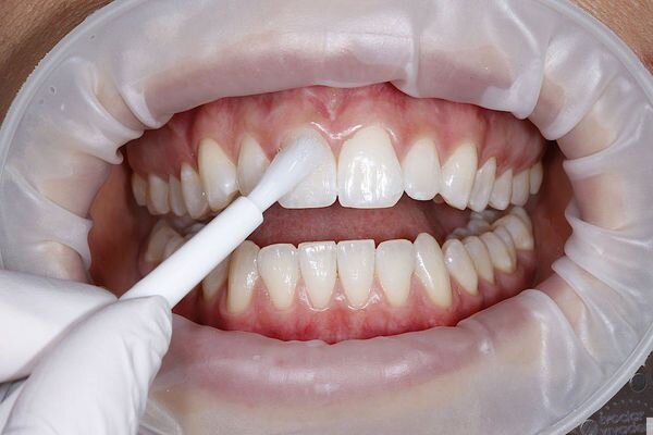 Нанесение фторлака на эмаль