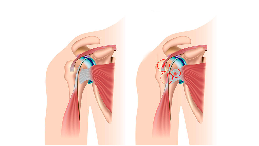 Тендинит сустава. Плечелопаточная периартропатия. Плечевой сустав. Сустав плеча.