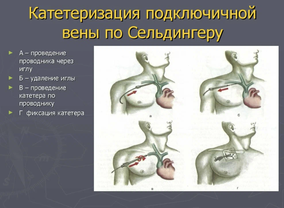 Пункция подключичной вены по сельдингеру. Пункция и катетеризация сосудов по методу Сельдингера. Пункция подключичной вены техника. Техника пункции и катетеризации подключичной вены по Сельдингеру. Подключичная катетеризация техника выполнения.