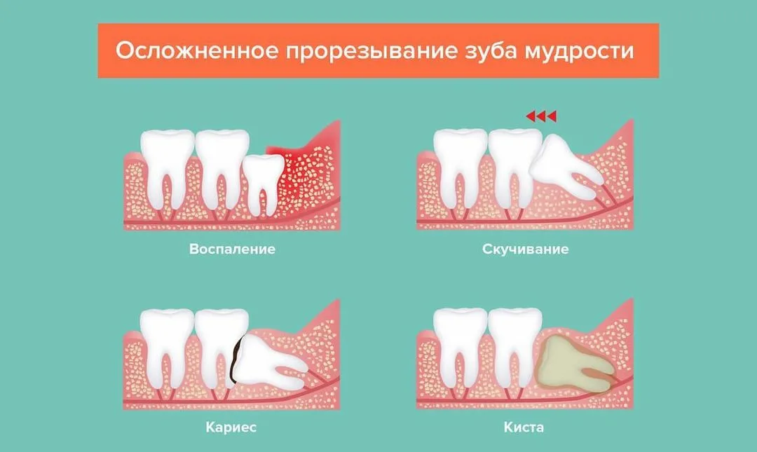 Причины отека после удаления зуба мудрости, как справиться с опухолью