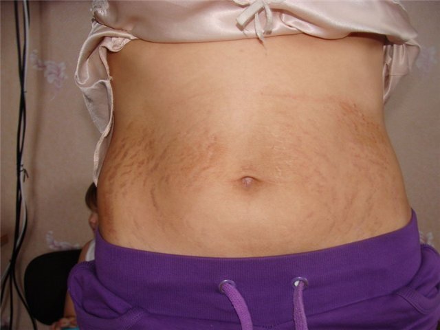 [caption id="attachment_121" align="alignleft" width="319"] Растяжки после родов[/caption]