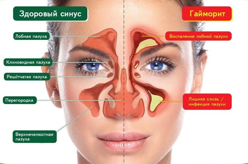 Постоянная заложенность носа у ребенка | блог клиники Наше Время