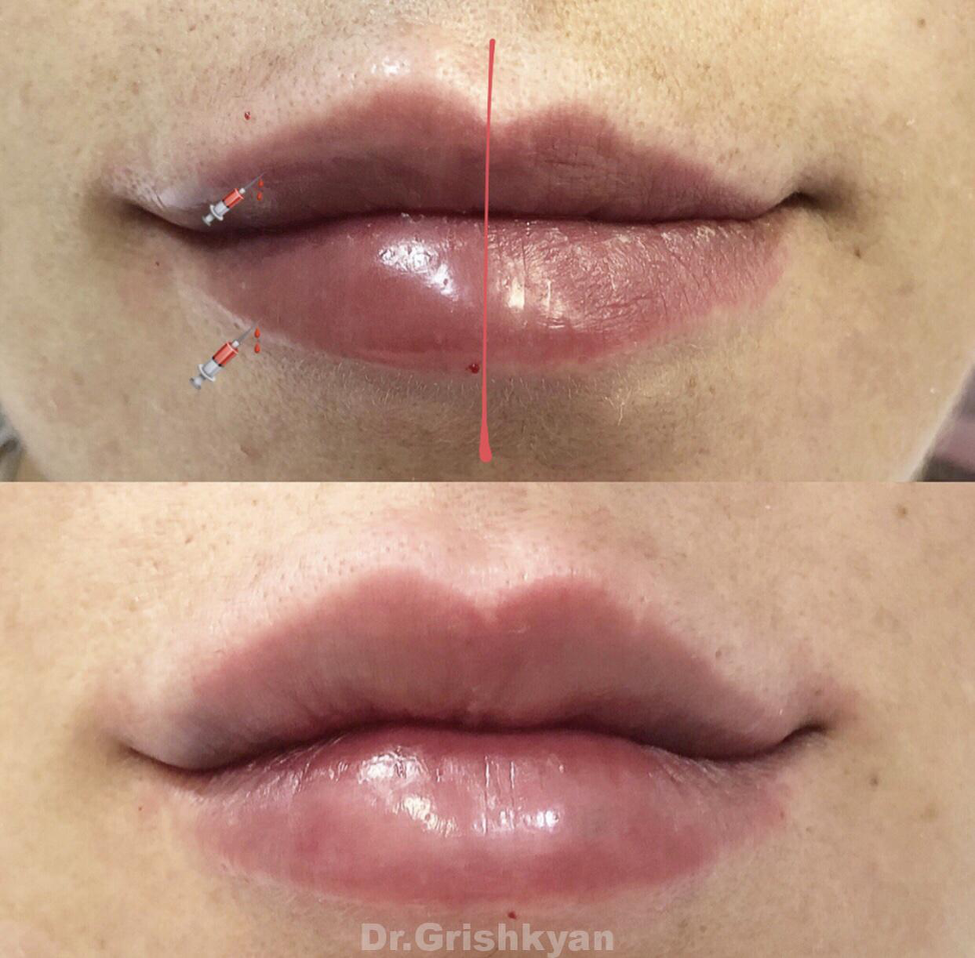 Фото с сайта клиники «Доктора Гришкяна» увеличение и коррекция ассиметрии губ у Комаровой Елены Станиславовны