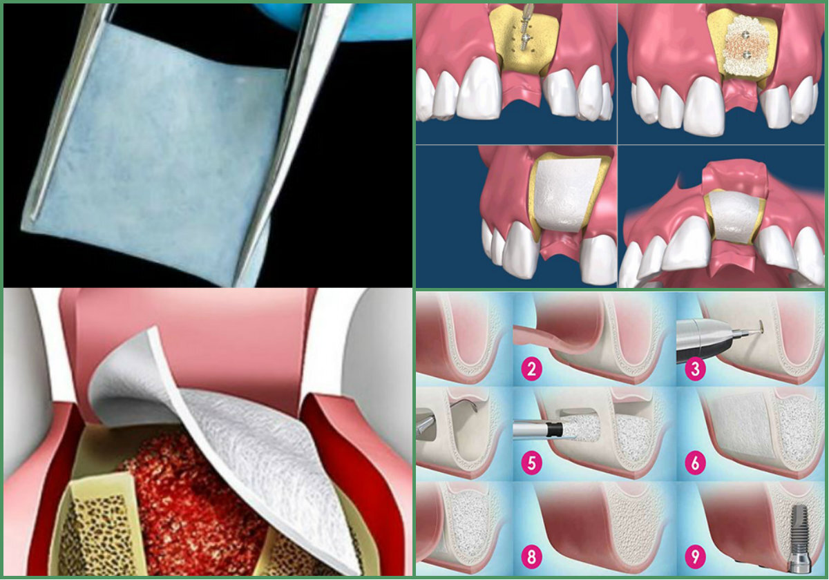 Костная пластика альвеолярного отростка. Пластика альвеолярного гребня.