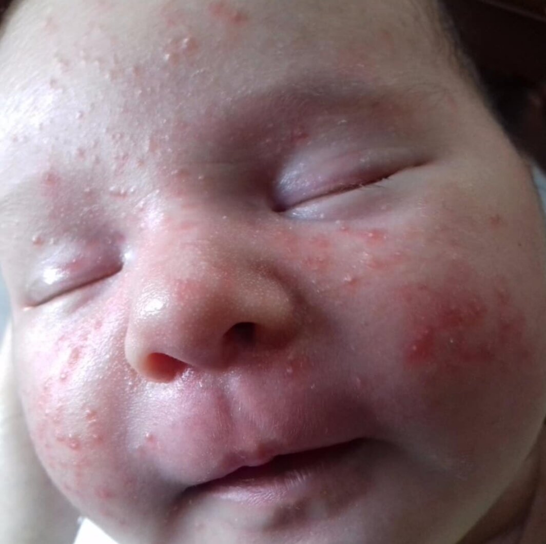 Диатез на лице у детей, аллергия, сыпь | Добромед