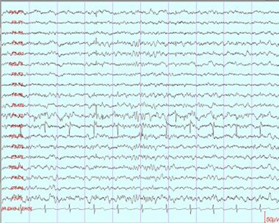 Эпилептиформные паттерны детства