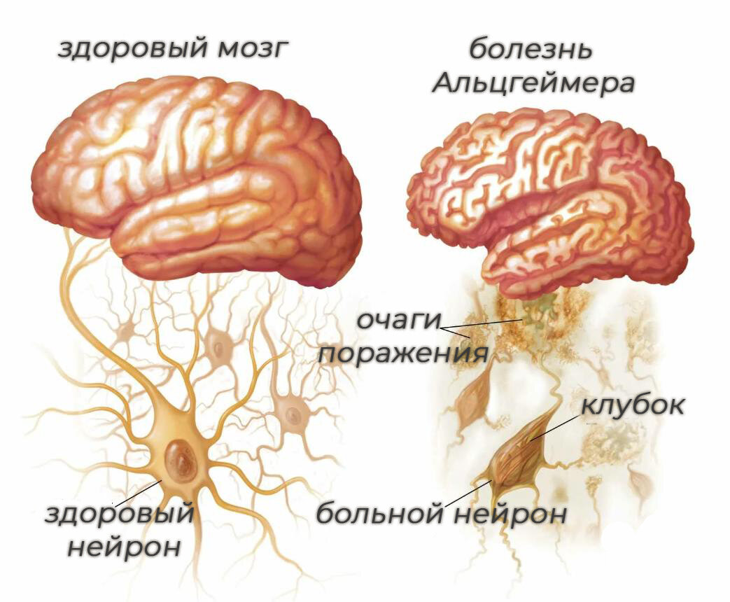 Можно ли вылечить болезнь Альцгеймера | Клиника психотерапии | Дзен