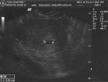 1 неделя беременности после зачатия