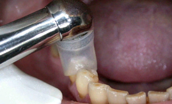 Лечение озоном.