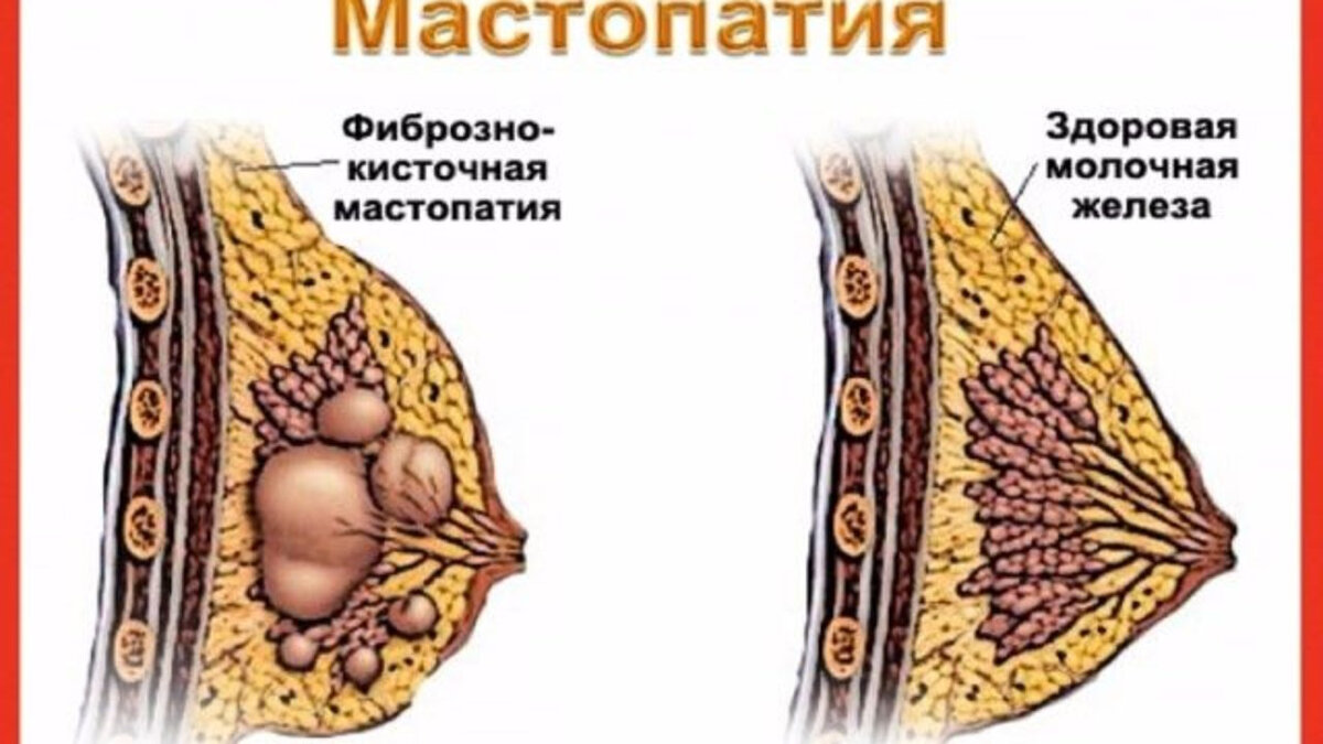 Мастопатия и её основные симптомы. Так ли она страшна? | О Здоровье | Дзен