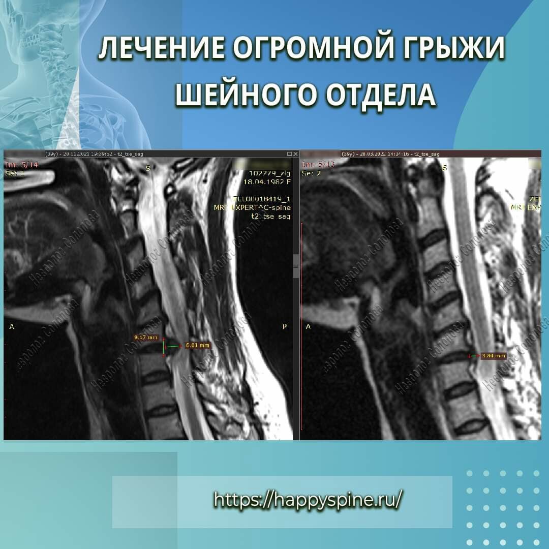 Промежуточный результат лечения огромной грыжи в шейном отделе | Красивая  осанка - здоровый позвоночник | Дзен