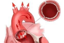 Уплотнение дуги аорты
