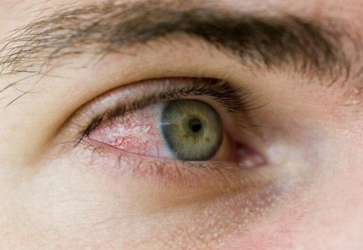 Ресничный клещ: почему появляется и как лечить