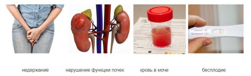  
Когда боль и дискомфорт становятся невыносимыми, женщины обращаются к врачу. И тогда им ставится диагноз - цистит (как правило, уже хронический). В подавляющем большинстве случаев это значит, что походы к урологу станут регулярными.