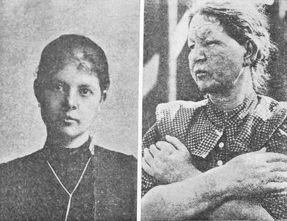 Больная лепрой до болезни в возрасте 23 лет и она же спустя 6 лет. Иллюстрация из книги Д.Ф. Решетилло. 