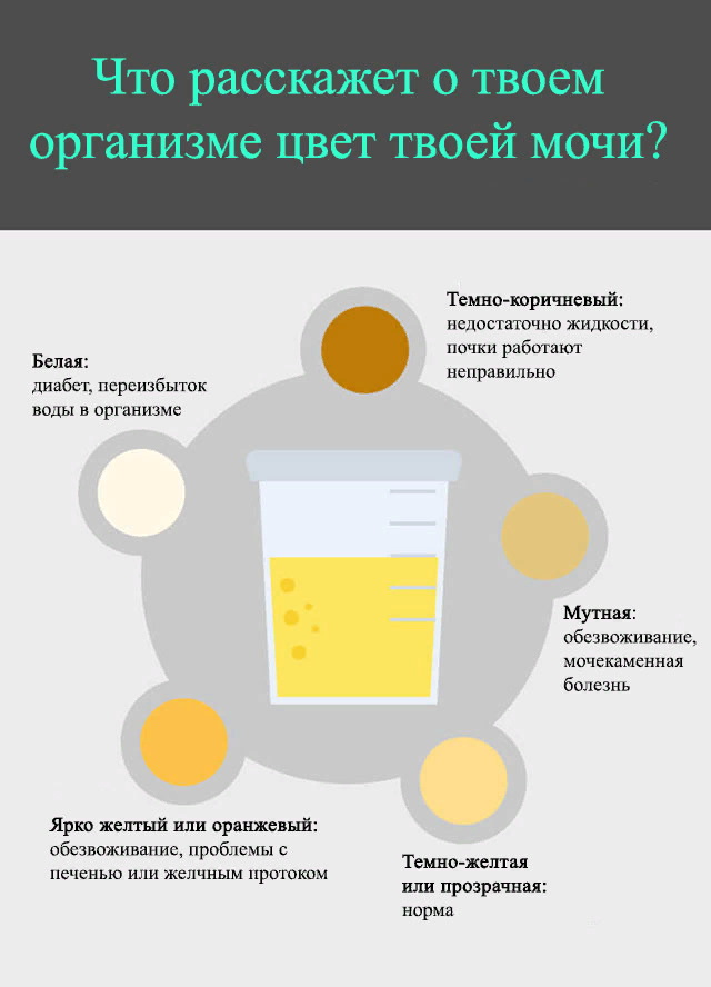 Цвет мочи. Изменение цвета мочи. Цвет мочи при сахарном диабете. Моча тёмнгжёллого цвета.
