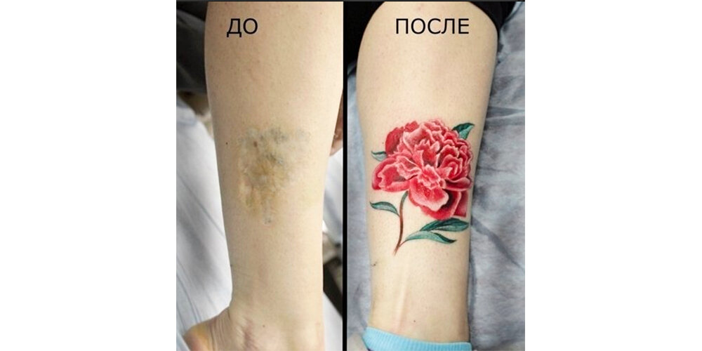 Скрытие шрама от ожога. Фото с crazytattoo.ru