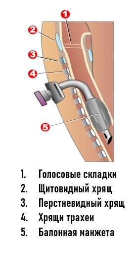 Схема трахеостомии