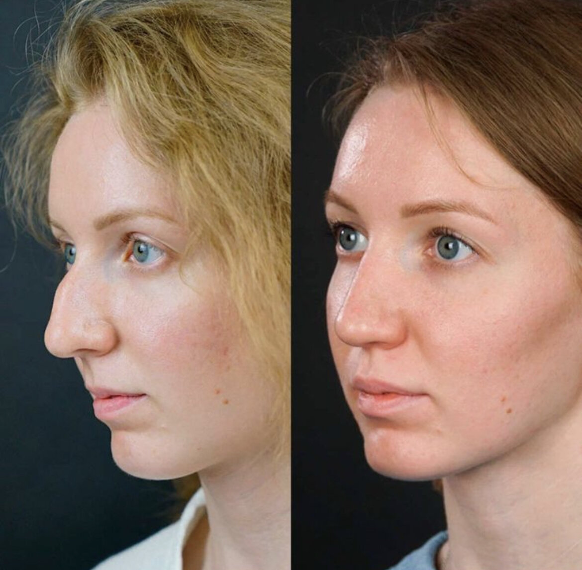 Хайбула камилович ринопластика. Как можно исправить нос. Ринопластика. Французский нос. Ринопластика длинного носа.