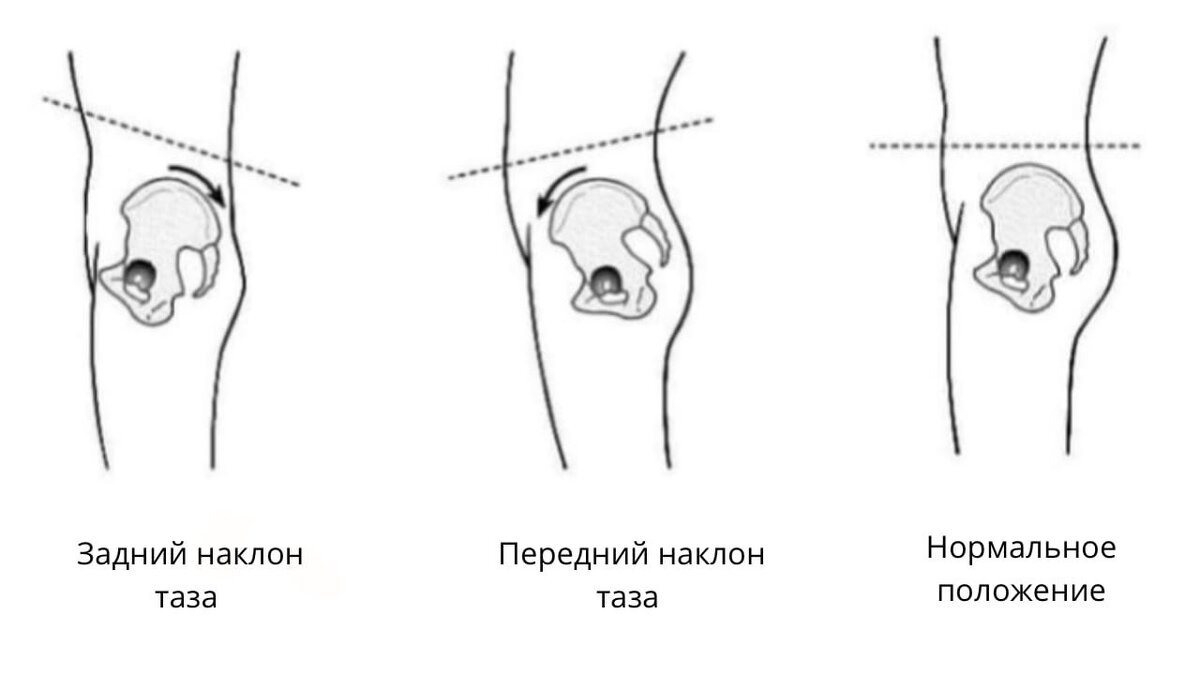 Положения члена. Передний наклон таза и гиперлордоз. Anterior Pelvic Tilt. Posterior Pelvic Tilt. Наклон таза вперед.