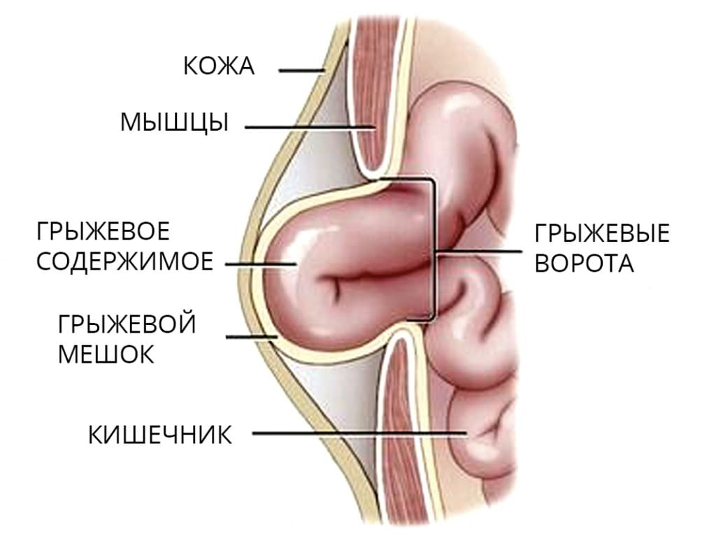 Грыжевые ворота грыжевой мешок. Послеоперационная вентральная грыжа. Ущемленная послеоперационная вентральная грыжа. Грыжевые ворота пупочной грыжи. Составные элементы грыжи.