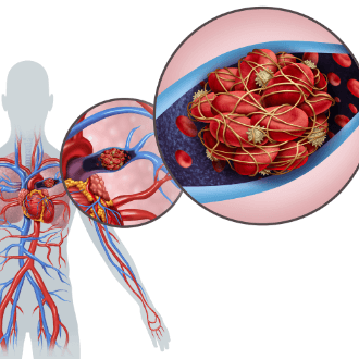 Здравствуйте! Меня зовут Ольга Юрьевна Топчая, по основной своей специальности я акушер-гинеколог и в своей практике занимаюсь обычными гинекологическими заболеваниями и проблемами, веду беременности. Наряду с нормально протекающими беременностями часто работаю и с особенными, которые называются беременностями высокого риска. Среди них особое место занимают проблемы, связанные с тромбофилией и другими нюансами свертывания крови. В таких ситуациях особенно необходимыми для врача-гинеколога являются знания и образование гемостазиолога. 
Что такое тромбофилия? Это нарушение работы в системе свертывания крови. Свертываемость крови или по-научному гемостаз — это способность организма поддерживать жидкое состояние крови и образовывать плотные тромбы при повреждении стенок кровеносных сосудов, а также растворение тромбов, выполнивших свою функцию.

Каждый человек в своей жизни наблюдал эту полезную способность нашего организма. Тут можно привести пример с порезанным пальцем или ежемесячными циклическими кровотечениями у женщин. Если свертываемость крови у человека в норме, то кровотечение останавливается, а тромб бесследно исчезает.

Эта способность свертываемости крови очень важна для наступления и правильного развития беременности. Вы скажете: «Беременность и причем тут тромбы и гемостаз!» Причина в гемохориальности связи организмов мамы и ее ребенка. Такой сложный медицинский термин означает то, что кровь матери и ребенка во-первых находится в самой непосредственной связи, а во-вторых, для осуществления этой связи необходимы изменения в сосудах матки, сходные с их травматизацией. А как мы говорили ранее, за травмой всегда следует образование тромба. Это нормально, так и должно быть при беременности! У беременных женщин всегда усиливается свертывание крови. Такова физиология беременности в балансе между неизбежным и необходимым.

Однако, порой это тонкое совершенство устройства организма дает сбой. Тогда кровь матери начинает слишком сильно реагировать на повреждение сосудов и образовывать тромбы чрезмерно быстро и сильно. Приведу аналогию. Представьте себе, что вы за рулем машины переезжаете «лежачий полицейский». Если сделать это на маленькой скорости, то все получится спокойно и ровно. А если же взять и разогнать машину до высокой скорости и не притормаживая влететь на это препятствие на дороге?! Все понимают, что так делать нельзя.

А вот наша кровь порой не «понимает», что нельзя. Старается изо всех сил закрыть тромбами этот участок матки, где происходит физиологическое повреждение стенок эмбрионом. В результате делает только хуже.

Почему так может происходить у некоторых беременных женщин? Причины тромбофилии бывают наследственные(врожденные) и приобретенные. Об имеющихся наследственных особенностях можно узнать из специального генетического анализа на мутации(полиморфизмы) гемостаза. Приобретенная тромбофилия бывает при некоторых заболеваниях и приеме препаратов, усиливающих свертываемость крови.

Как проявляет себя тромбофилия во время беременности и кто нуждается в обследовании на особенности свертывания крови? Это сделать рекомендуется в следующих случаях:

При наличии в прошлом невынашивания беременности, внутриутробной задержки роста ребенка, случаев преэклампсии(гестоза), отслойки плаценты, антенатальной гибели плода.
Неудачные попытки ЭКО
Любые случаи тромбоза у пациентки в прошлом
При повышении в крови уровня антифосфолипидных антител
При отягощенном семейном анамнезе, т.е. Когда у ближайших родственников были случаи сосудистых осложнений(инсульты, инфаркты, тромбозы) в возрасте до 50 лет
Во всех этих случаях при раннем обращении пациентки к врачу, можно исправить ситуацию. Очень важно для успеха лечения тромбофилии уметь диагностировать ее до наступления беременности. Тогда с помощью совсем небольших доз легкодоступных препаратов и без использования сложных инвазивных методик, можно полностью скорректировать особенности гемостаза пациентки для успешной беременности.

Такое лечение подбирается индивидуально каждой пациентке, исходя из ее анамнеза жизни и особенностей здоровья. Сейчас имеется достаточно большой опыт по преодолению репродуктивных проблем, связанных с тромбофилией. Помочь можно в абсолютном большинстве таких случаев. Поэтому, не бойтесь и не переживайте. Все поправимо!

Автор статьи: Врач Акушер-гинеколог Топчая О.Ю