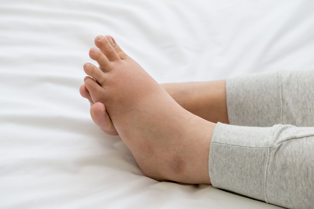 Отеки ног, причины и лечение отечности ног