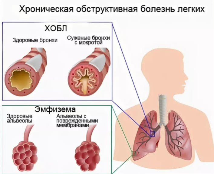 Профилактика хобл презентация