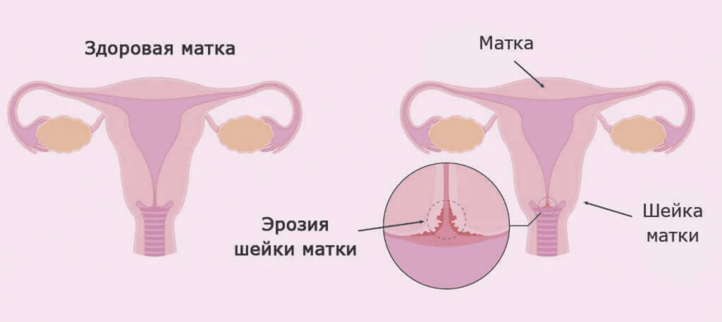 Эрозия шейки матки