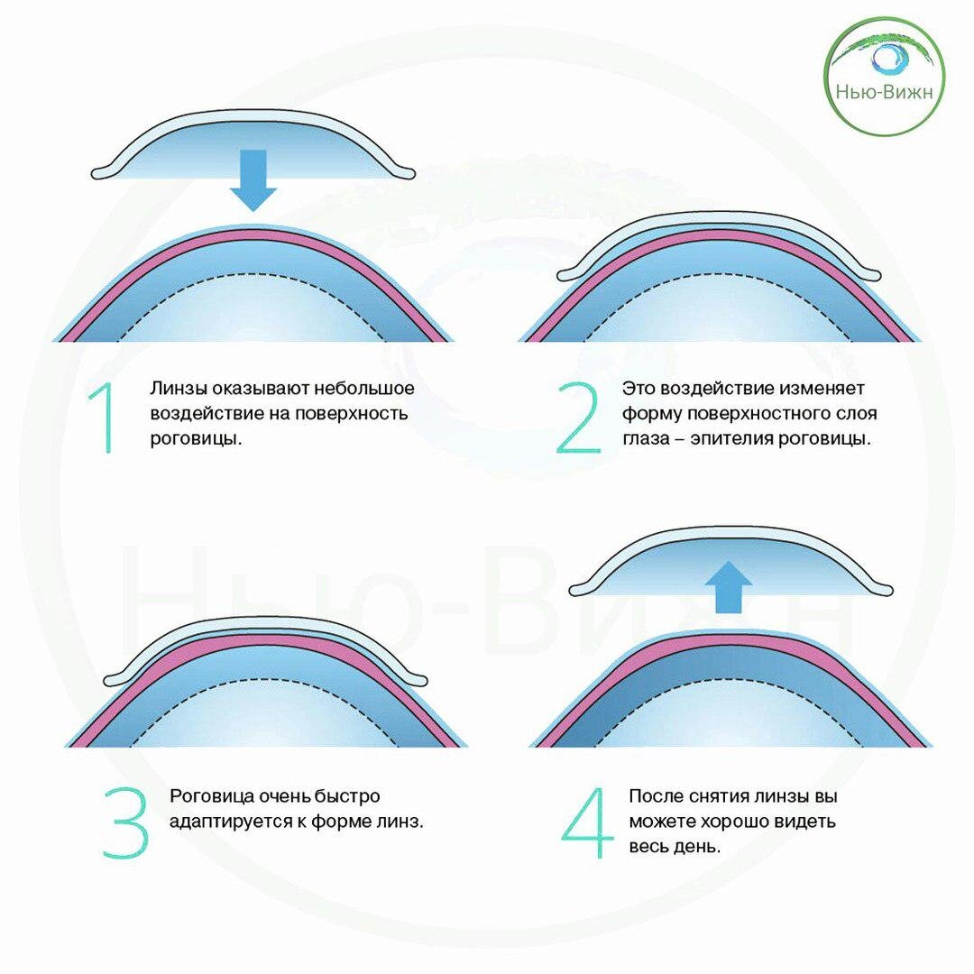 Эффект применения орто-линз (из собственных материалов)