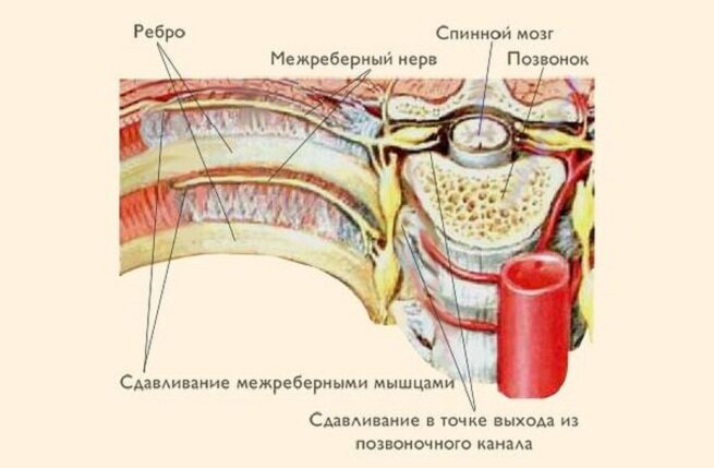 Как лечить межреберную невралгию – рекомендации практикующего врача — клиника «Добробут»