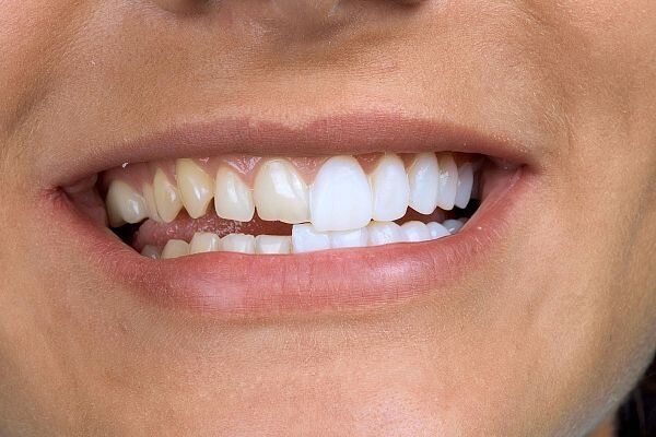 Когда можно протезировать зубы частями, а когда обязательно все сразу?