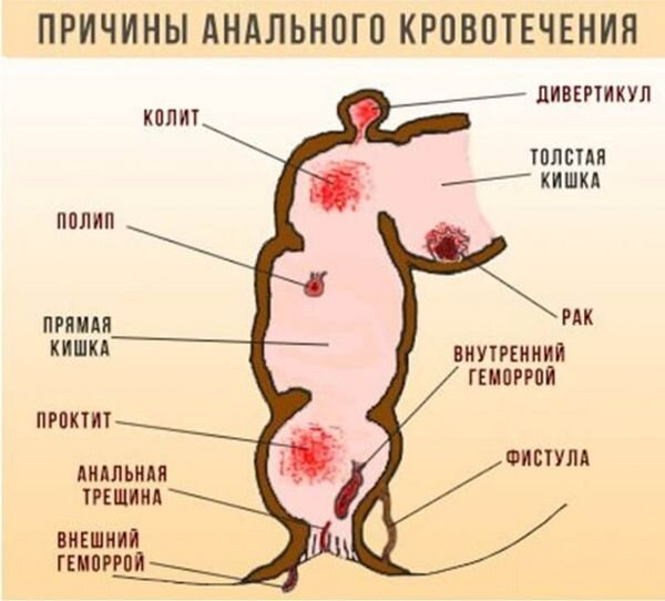 Кровоточивость из прямой кишки