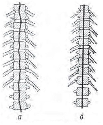 Позвоночник юного пловца (а). Остистые отростки располагаются по извилистой линии. Позвоночник юного штангиста (б). Остистые отростки располагаются строго по средней линии (изображение схематическое) (Из книги А.И.Кураченкова «Изменения костно-суставного аппарата у юных спортсменов», М., ФиС, 1958). 