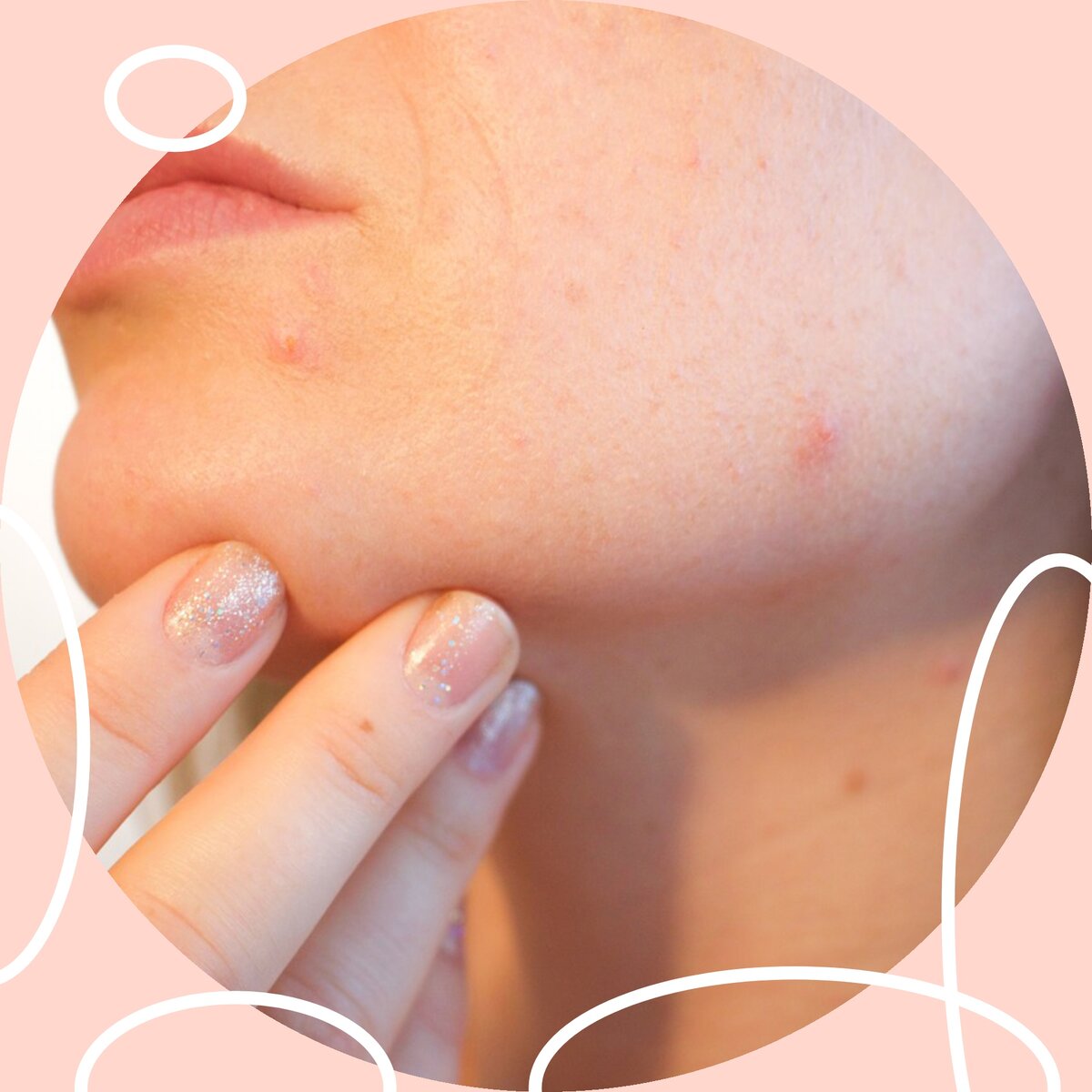 Прыщи ложечками не давить. Они предназначены только для очищения пор