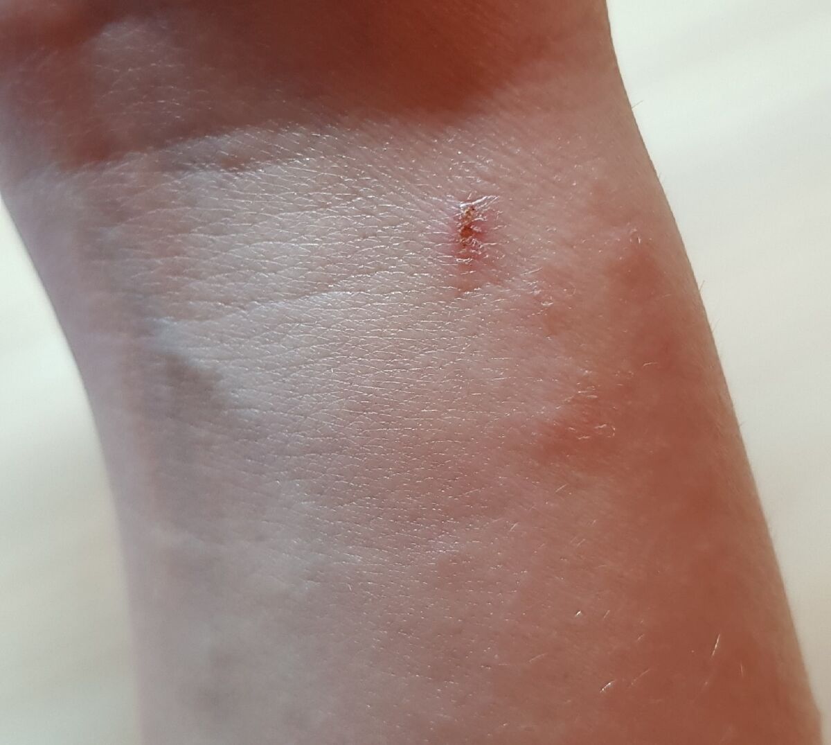 Рука в период обострения атопического дерматита