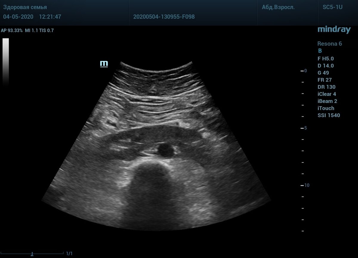 Подковообразная почка по УЗИ. Подковообразная почка на УЗИ У плода. Перешеек подковообразной почки УЗИ. Подковообразная почка УЗИ заключение.