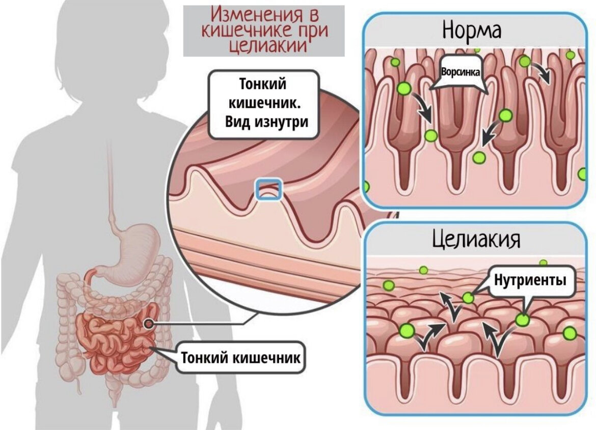 Целиакия стол